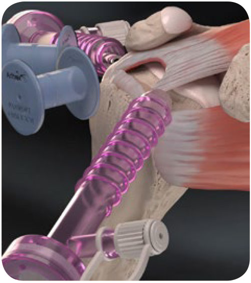 Image: /images/articulos/hombro/10_preguntas_clave_lesion_manguito_rotadores/img-1.jpg