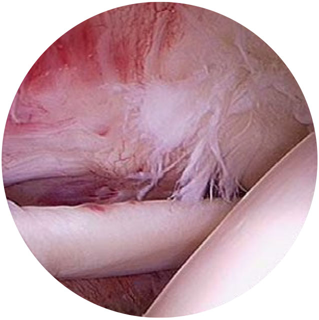 Image: /images/articulos/hombro/10_preguntas_clave_lesion_manguito_rotadores/img-2.jpg