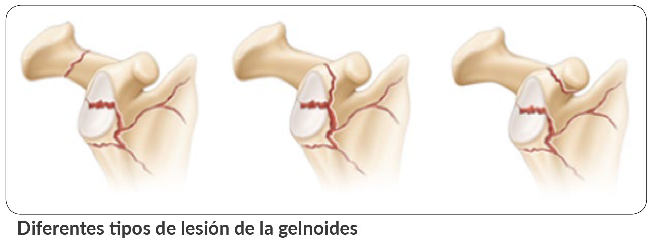 Image: /images/articulos/hombro/10_preguntas_clave_luxacion_hombro/img-3.jpg