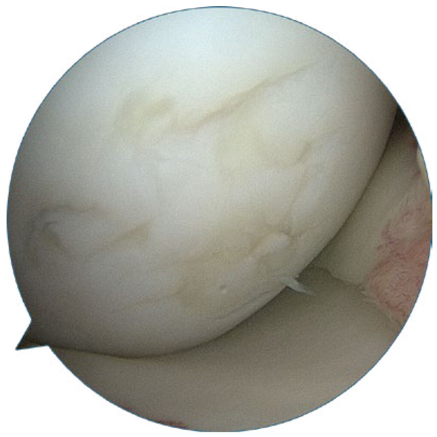 Image: /images/articulos/rodilla/10_preguntas_clave_cartilago_articular/img-3.jpg