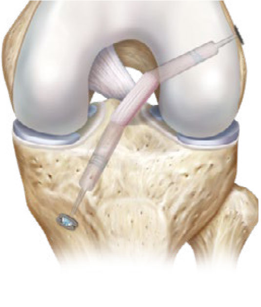 Image: /images/articulos/rodilla/10_preguntas_clave_cartilago_articular/img-5.jpg