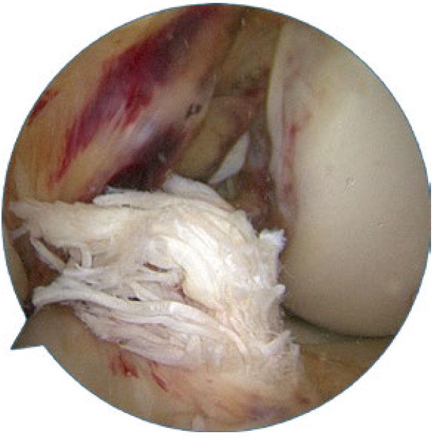 Image: /images/articulos/rodilla/10_preguntas_clave_cartilago_articular/img-6.jpg
