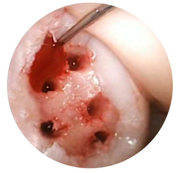 Image: /images/articulos/rodilla/10_preguntas_clave_cartilago_articular/img-7.jpg