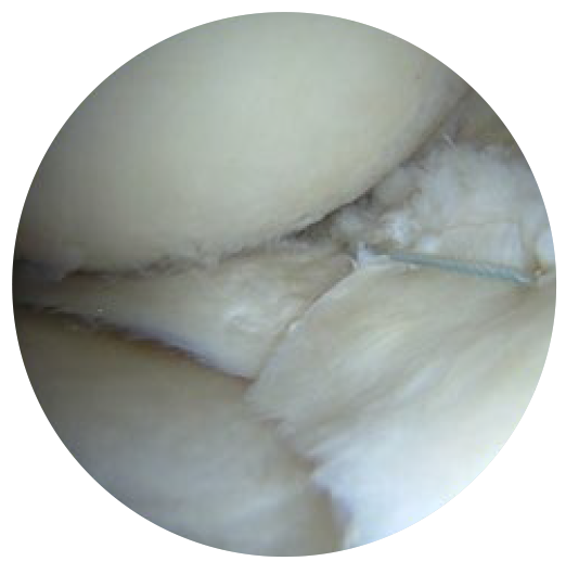 Image: /images/articulos/rodilla/10_preguntas_clave_ligamento_cruzado_anterior/img-10.png