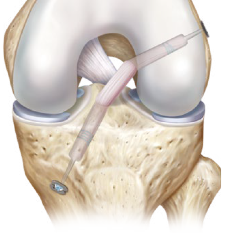 Image: /images/articulos/rodilla/10_preguntas_clave_ligamento_cruzado_anterior/img-3.png