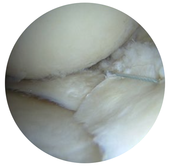 Image: /images/articulos/rodilla/10_preguntas_clave_ligamento_cruzado_anterior/img-4.png
