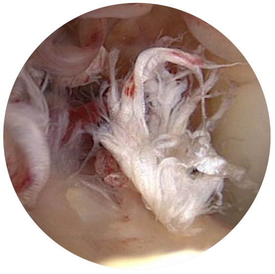 Image: /images/articulos/rodilla/10_preguntas_clave_ligamento_cruzado_anterior/img-5.png
