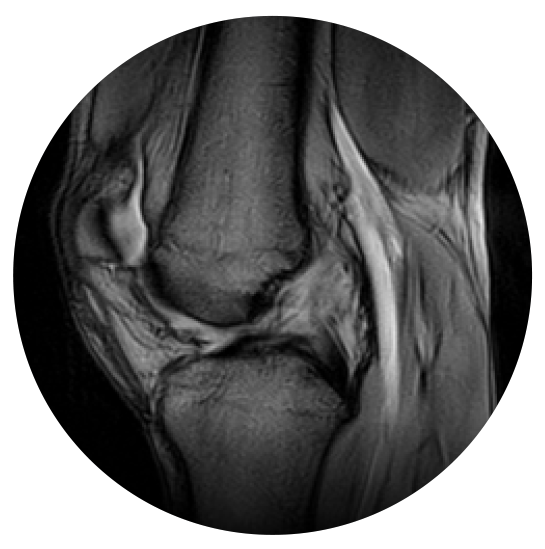 Image: /images/articulos/rodilla/10_preguntas_clave_ligamento_cruzado_anterior/img-6.png