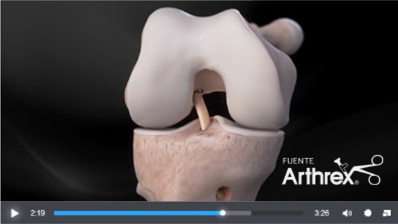 Image: /images/articulos/rodilla/10_preguntas_clave_ligamento_cruzado_anterior/img-8.png