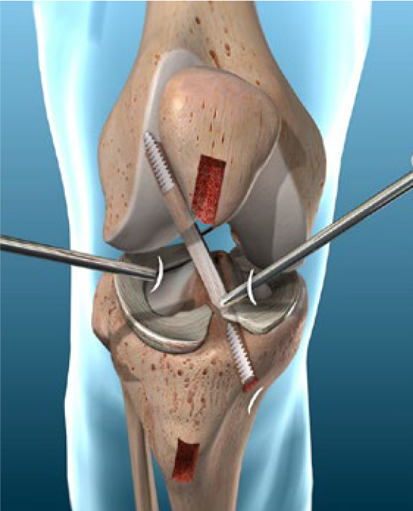 Image: /images/articulos/rodilla/10_preguntas_clave_ligamento_cruzado_anterior/img-4.png