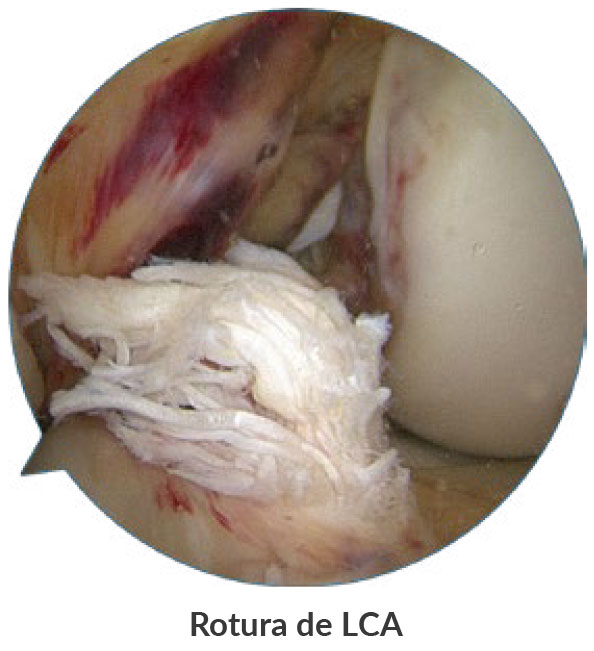Image: /images/articulos/rodilla/10_preguntas_clave_ligamento_cruzado_anterior_mujer/img-1.jpg
