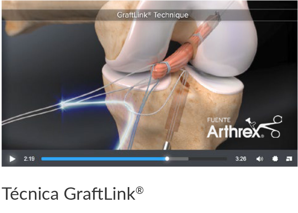 Image: /images/articulos/rodilla/10_preguntas_clave_ligamento_cruzado_anterior_mujer/img-4.jpg