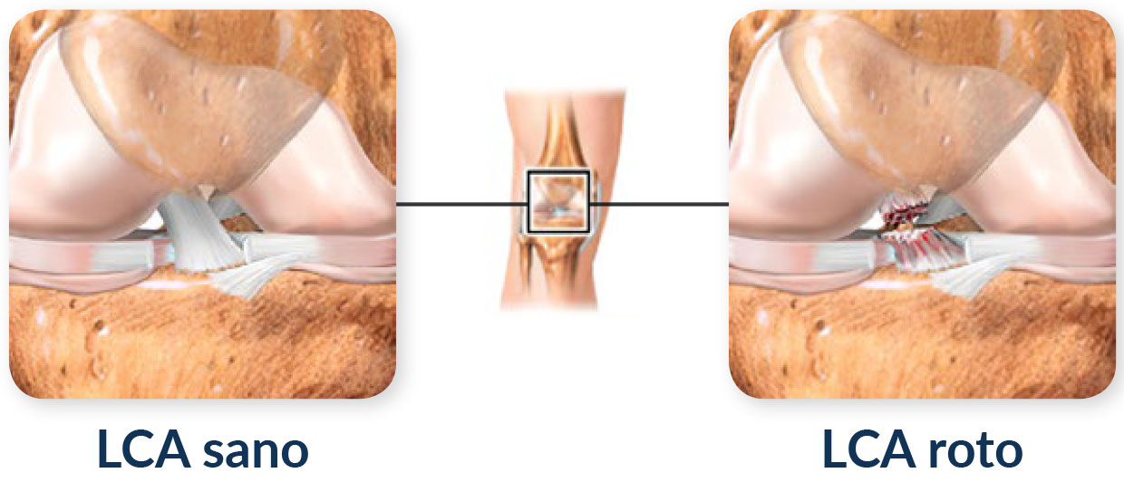 Image: /images/articulos/rodilla/10_preguntas_clave_ligamento_cruzado_anterior_nino/img-1.jpg