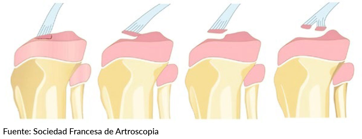 Image: /images/articulos/rodilla/10_preguntas_clave_ligamento_cruzado_anterior_nino/img-3.jpg